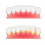 The initial stage of gingivitis is tartar