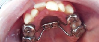 palatal expander