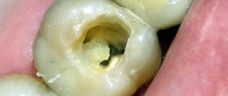 Неполное раскрытие полости зуба.