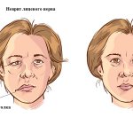 Неврит лицевого нерва: симптомы и лечение