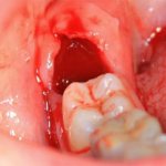 Is it normal if your mouth does not open after wisdom tooth removal? How can I solve the problem? 