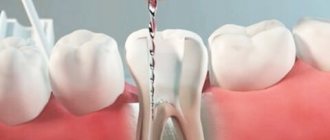 Root canal treatment