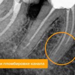 Error when filling a canal on x-ray