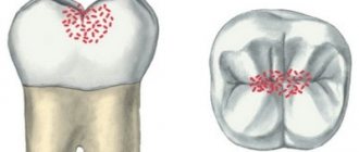 Features of superficial caries