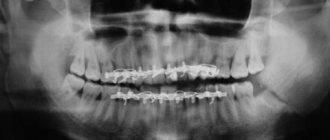 osteosynthesis