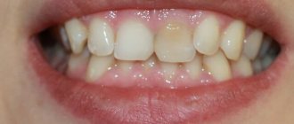 Whitening a pulpless tooth