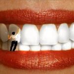 отбеливание фторирующим лаком для зубов