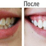 Teeth whitening with gel: before and after photos