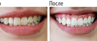 Teeth whitening with gel: before and after photos