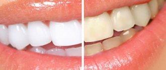 Teeth whitening