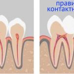 lack of proper contact point between teeth