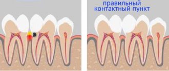 lack of proper contact point between teeth