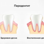 Periodontitis in pictures