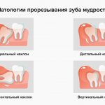 Патологии прорезывания зуба мудрости в картинках