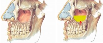 Perforation of the maxillary sinus