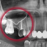 perforation of the maxillary sinus