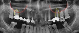 Perforation of the maxillary sinus