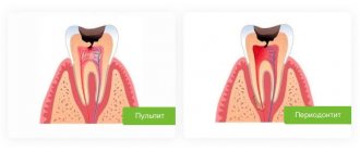 периодонтит и пульпит