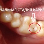 The first stage is the initial stage of caries - when a chalky stain appears on the tooth