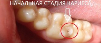 The first stage is the initial stage of caries - when a chalky stain appears on the tooth