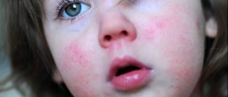 Food allergies in children: diagnosis