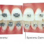 Why do Damon braces come off faster than regular braces?