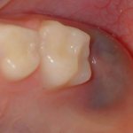 Why do my gums turn blue?