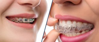 Benefits of correcting your bite with mouthguards