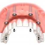 benefits of implant prosthetics