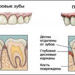 The drug is prescribed for inflammatory pathologies of the oral cavity