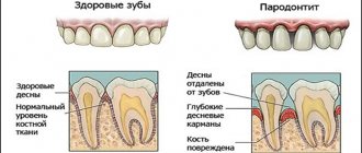 Препарат назначается при воспалительных патологиях ротовой полости