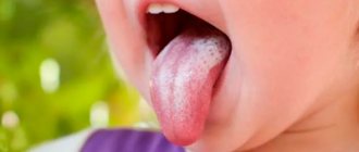 Causes of yeast glossitis - Line of Smile Dentistry