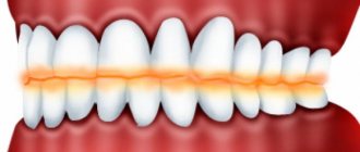 Causes of increased tooth wear