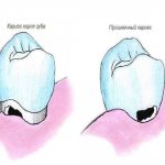 Cervical caries