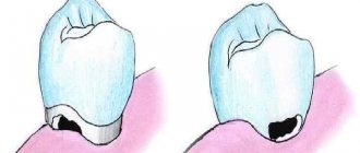 Cervical caries