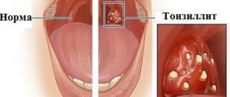 signs of tonsillitis