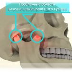 Problem areas of the temporomandibular joint