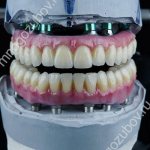 implant supported dentures