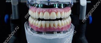 implant supported dentures