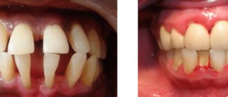 different stages of periodontitis