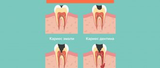 Development of pulpitis in pictures