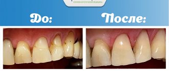 Результат реставрации зубов в клинике МедЛайн