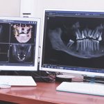 Jaw x-ray results