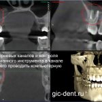 ри проведении первичной диагностики КЛКТ мы выявили факт расположения сломанного инструмента в корневом канале