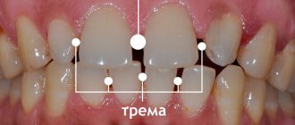 Gaps between teeth