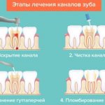 Dental canal treatment plan