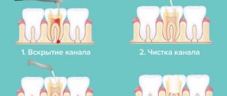 Dental canal treatment plan