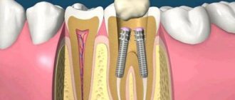 Pin in tooth