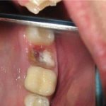 A tooth has broken at the root - what to do?