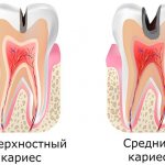 Стадии кариеса